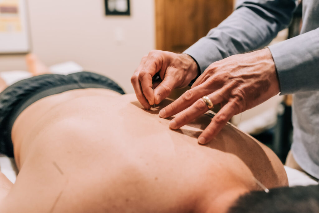 Acupuncture in Steamboat